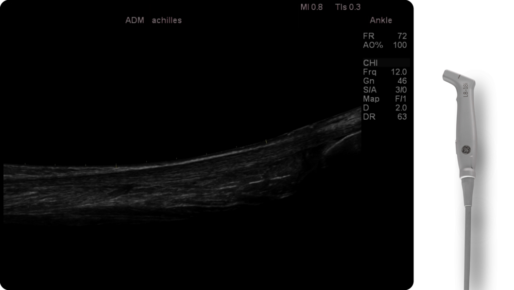 Achilles LOGIQe with L8-18i probe