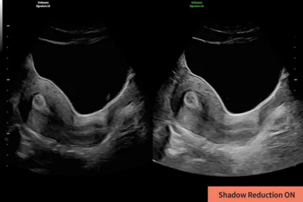 Split-screen ultrasound image comparing standard imaging to Shadow Reduction ON, demonstrating improved tissue and border visibility.