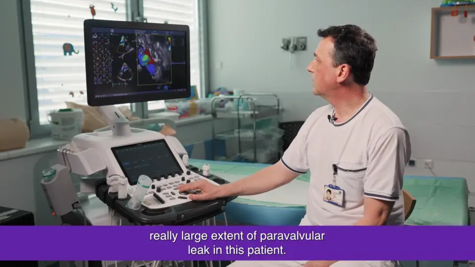 Usefulness of 3D TEE in the diagnosis of heart disease in children