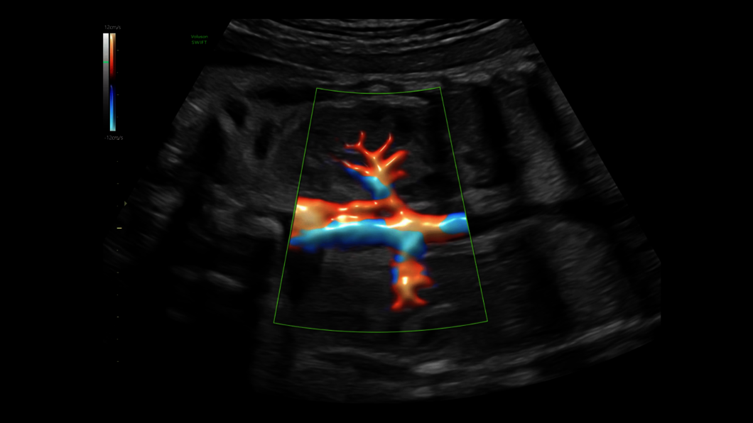 Ultrazvukový snímek aorty a ledvin zachycený pomocí funkce Radiantflow