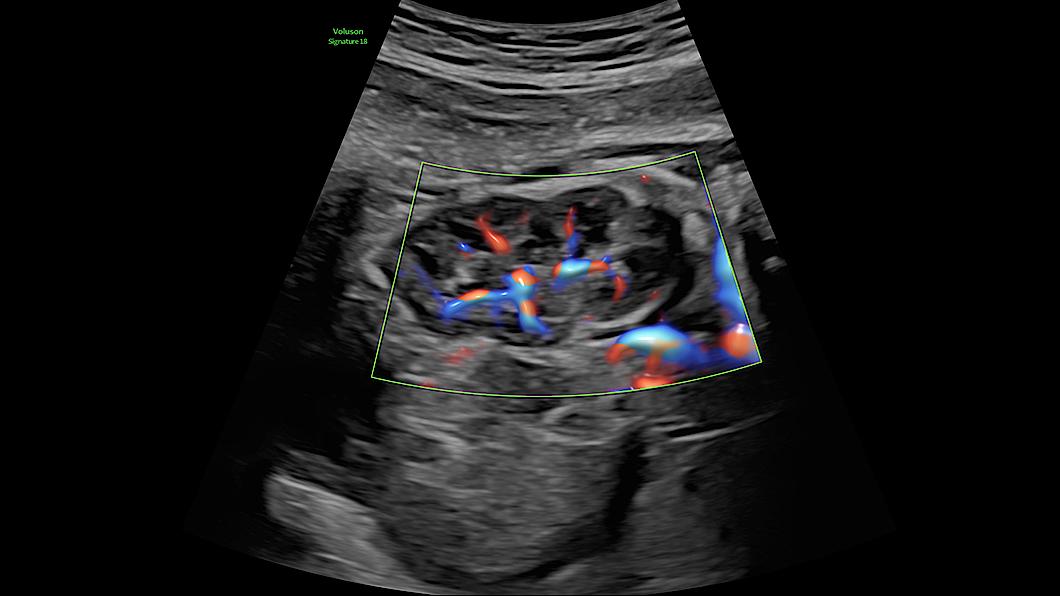 Fetal kidney