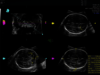 Ultrazvukový snímek mozku plodu zachycený pomocí funkce SonoCNS