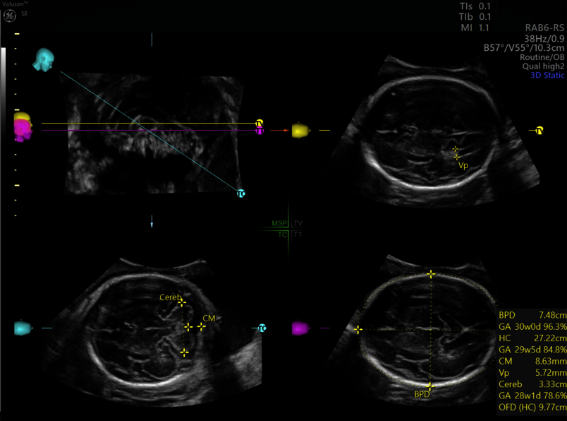 Ultrazvukový snímek mozku plodu zachycený pomocí funkce SonoCNS