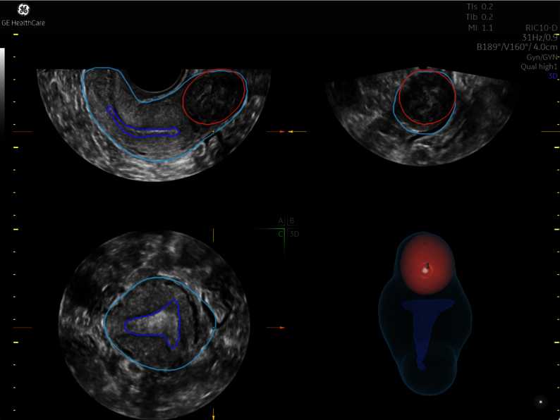 Fibroid Mapping Tool