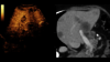 Liver lesions ultrasound image