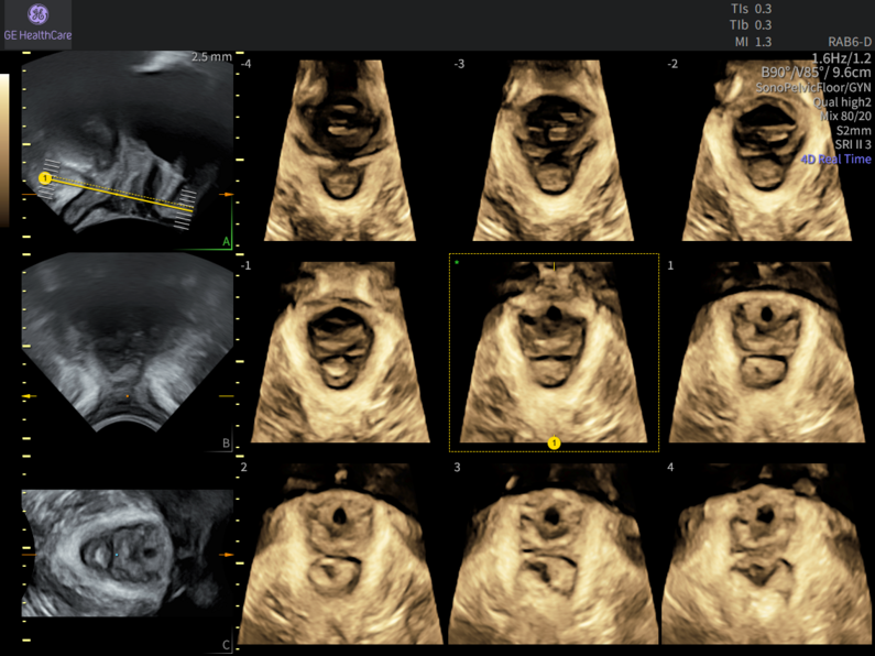 Tomographic ultrasound view of the pelvic floor showing multiple sequential slices used for SonoPelvicFloor assessment.