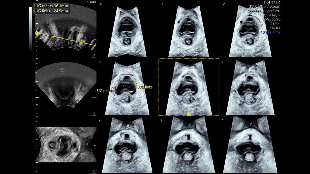 clinical image with SonoPelvicFloor