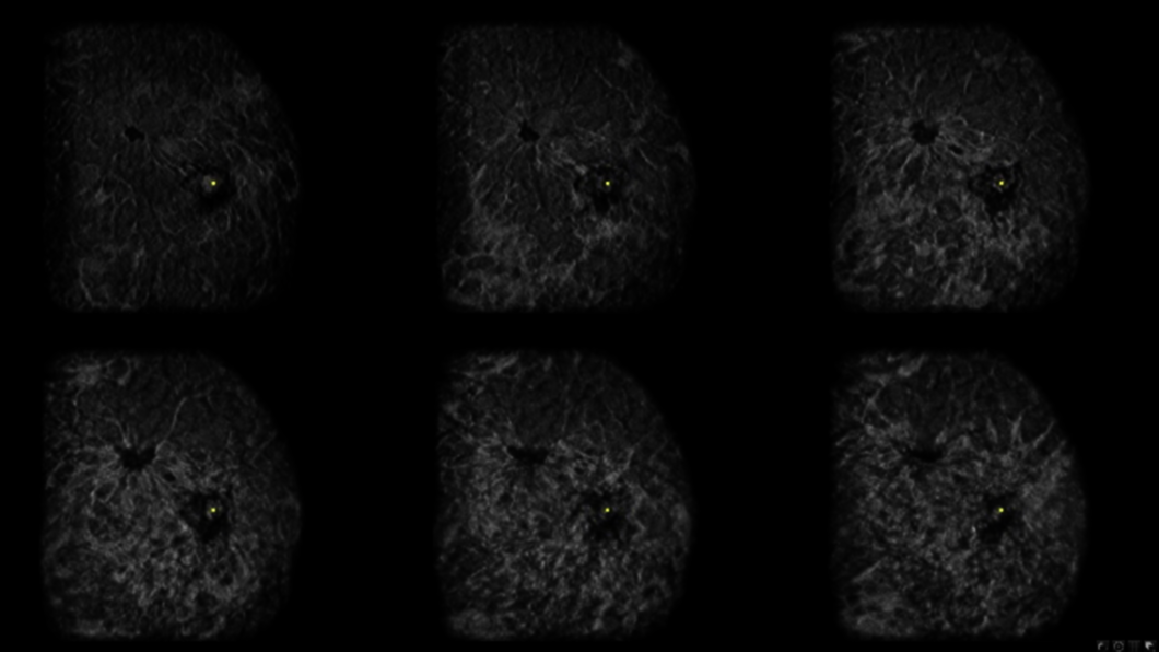 Ultrazvukový snímek ženského prsu ve více řezech