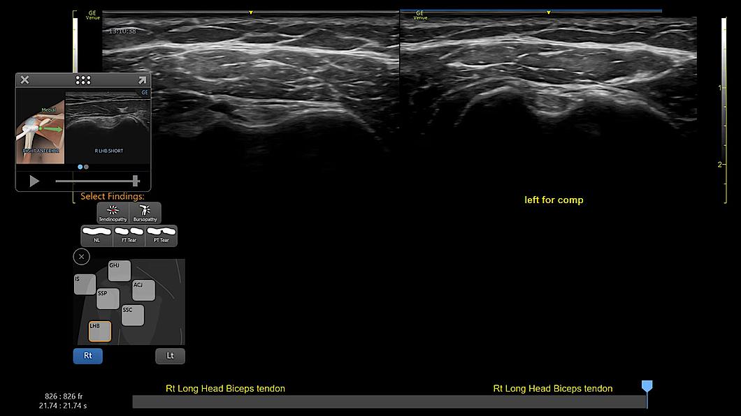 Ultrazvukový snímek zachycený pomocí diagramu ramene