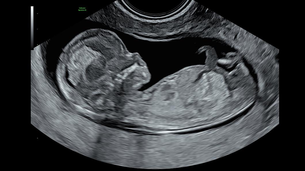 12 week fetus