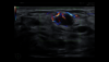 Ultraschallbild Mammasonographie mit Dopplerdiagnostik