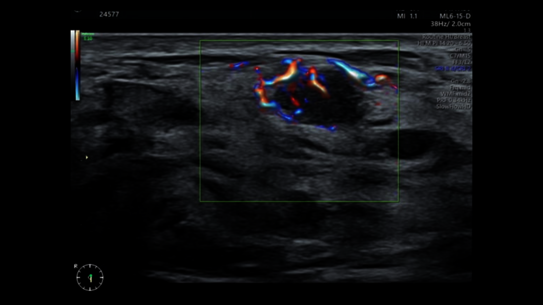 Ultraschallbild Mammasonographie mit Dopplerdiagnostik