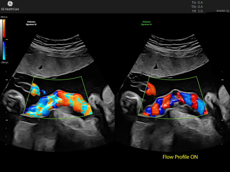 Side by side color Doppler comparison showing standard flow display on the left and Flow Profile ON on the right, with distinct color segmentation of blood flow velocity.