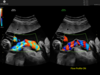 Side by side color Doppler comparison showing standard flow display on the left and Flow Profile ON on the right, with distinct color segmentation of blood flow velocity.
