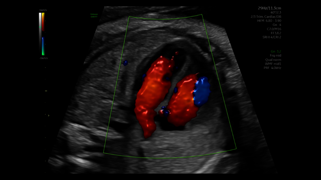 Ultrazvukový snímek obličeje 26týdenního plodu zachycený pomocí funkce Radiantflow