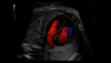 Ultrasound image of a 26-week fetal heart captured with Radiantflow