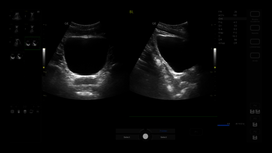 Ultrazvukový snímek: Měchýř na dvou obrazovkách