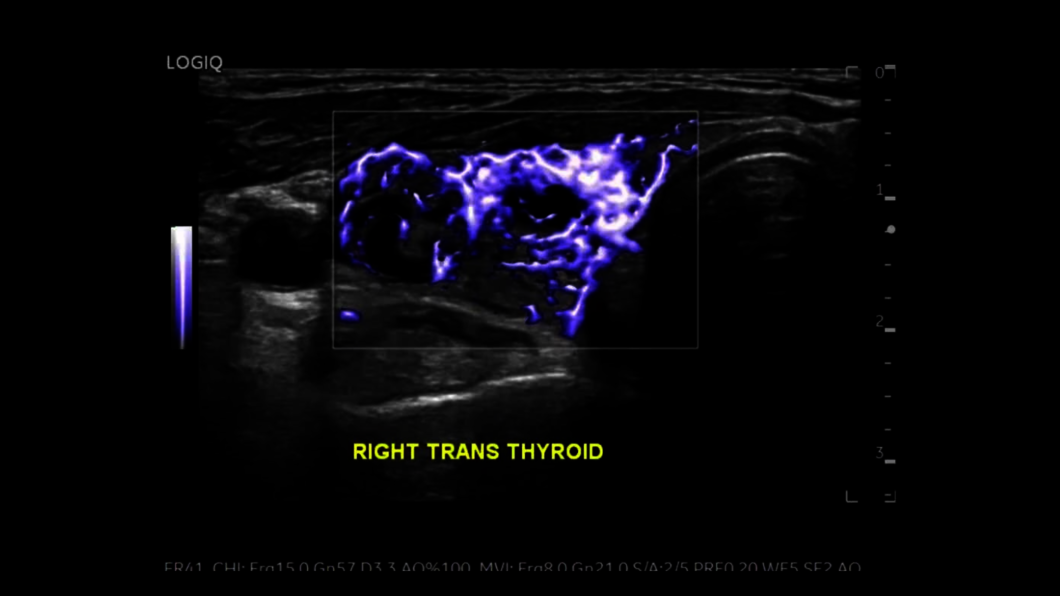Thyroid Micro Vascular Imaging
