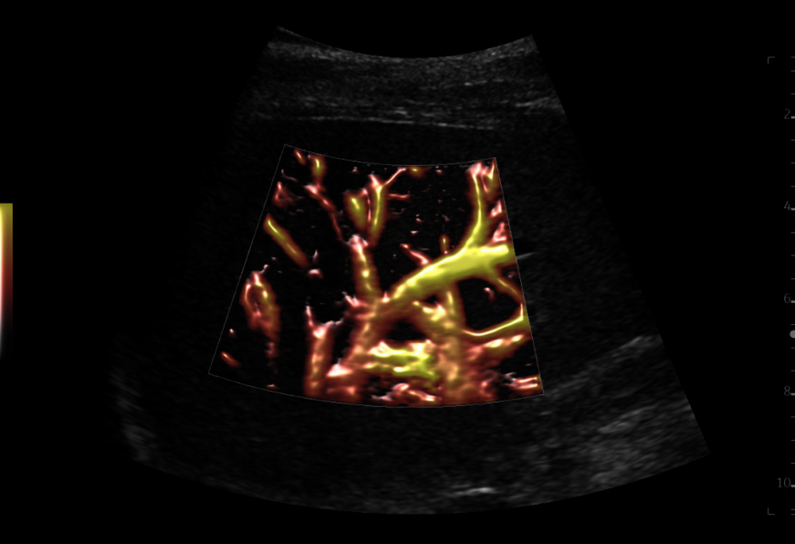 Liver ultrasound image