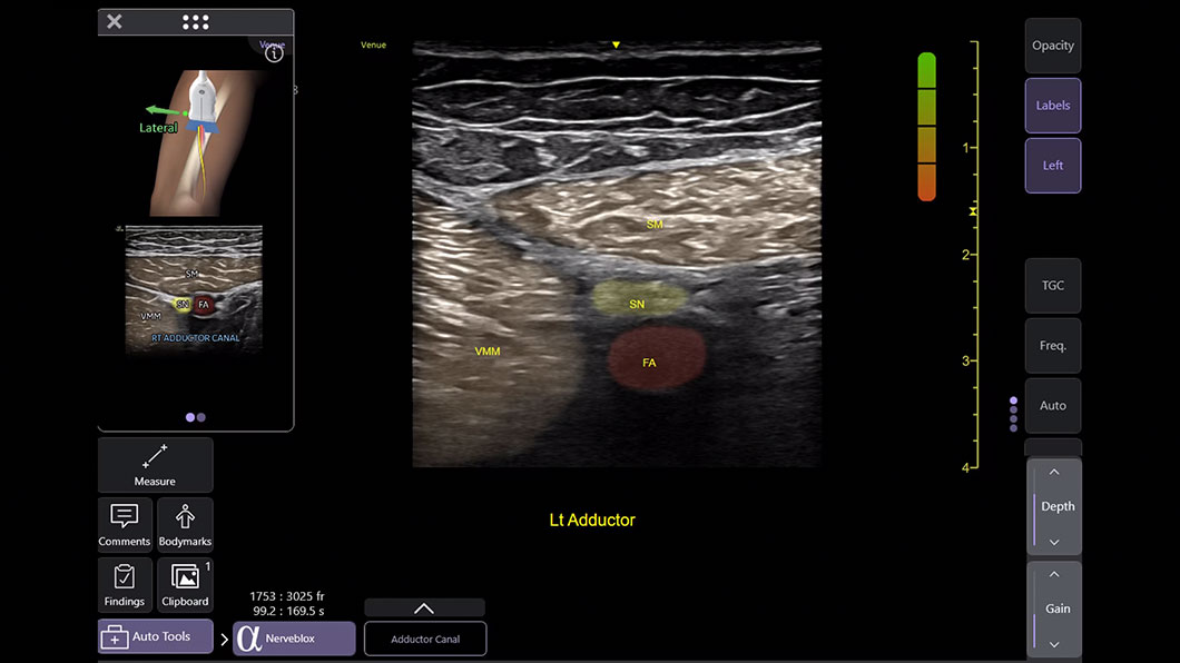 répérage des blocs nerveux périphériques
