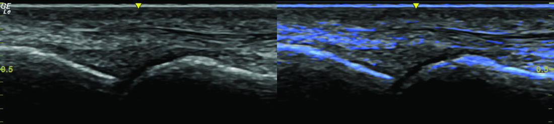 Ultrazvukový snímek při MSK vyšetření