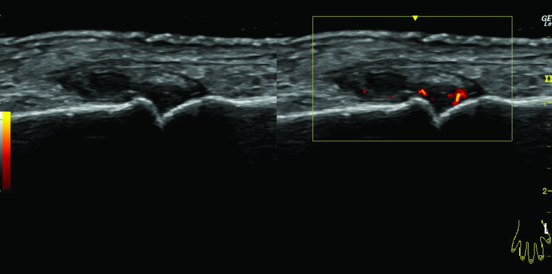Ultrasound image of a vascular exam