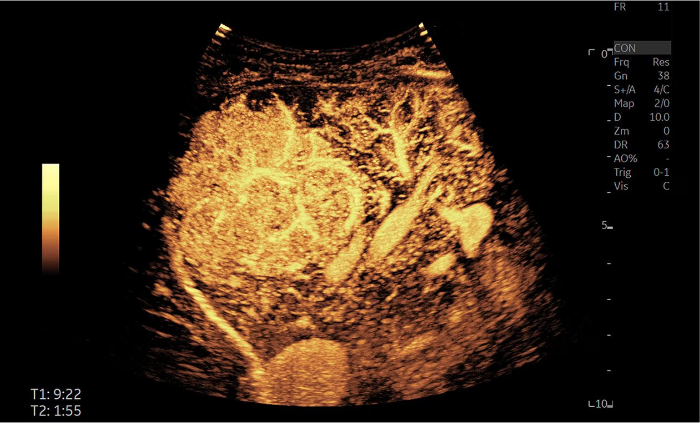 CEUS ultrasound image