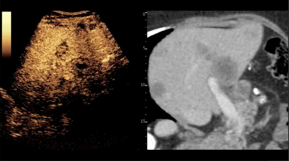 Liver lesions ultrasound image