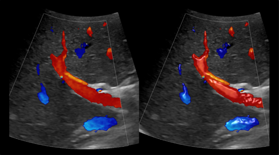 Liver vasculature ultrasound image