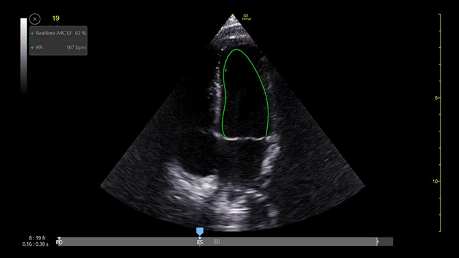 Ultrazvukový snímek zachycený pomocí funkce EF v reálném čase