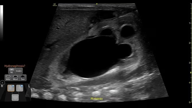 Ultrazvukový snímek zachycený pomocí renálního diagramu