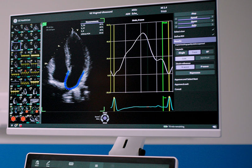 Close-up of a GE Healthcare ultrasound monitor displaying an echocardiogram heart view alongside a strain curve graph and diagnostic measurement panels.