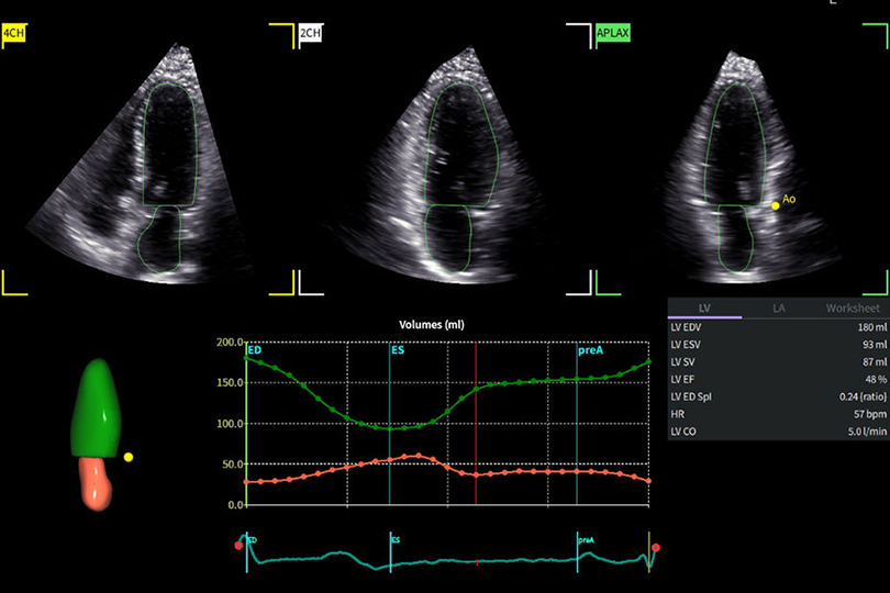 Software interface displaying three simultaneous echocardiogram views with highlighted left ventricles, alongside a dynamic volume graph, 3D model, and measurement worksheet.