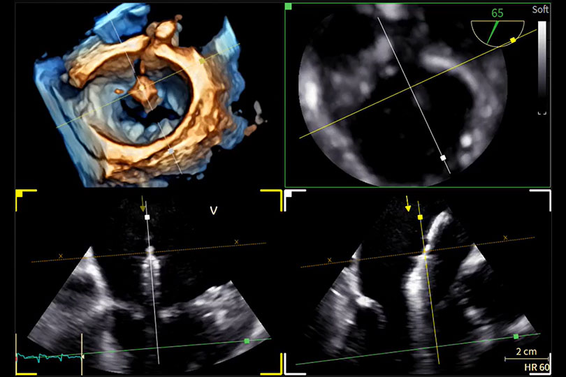 Close-up of NUVISION and AcuNav Crystal ultrasound catheters resting in the probe holders of a GE ultrasound control panel.