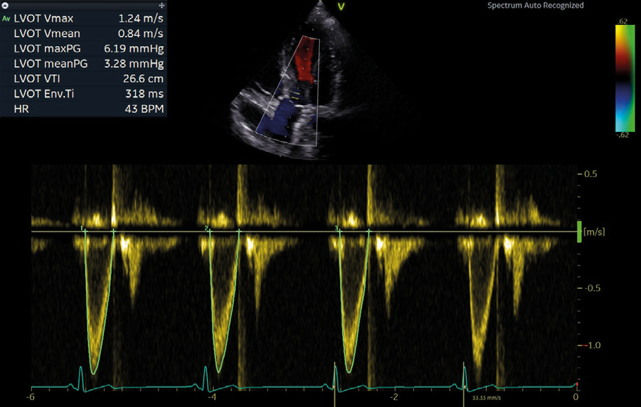 Clinical image captured using AI Cardiac Auto Doppler