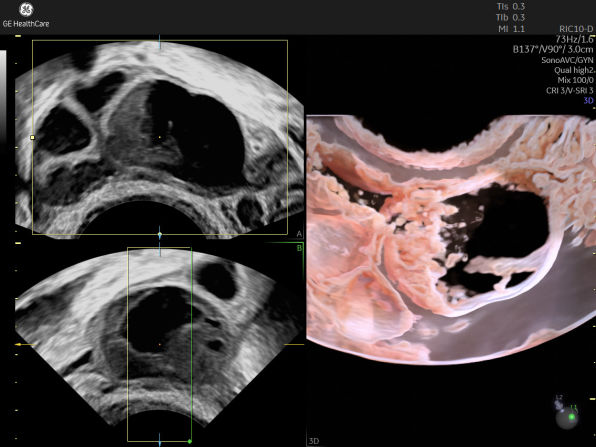 Ovary 3D ultrasound image