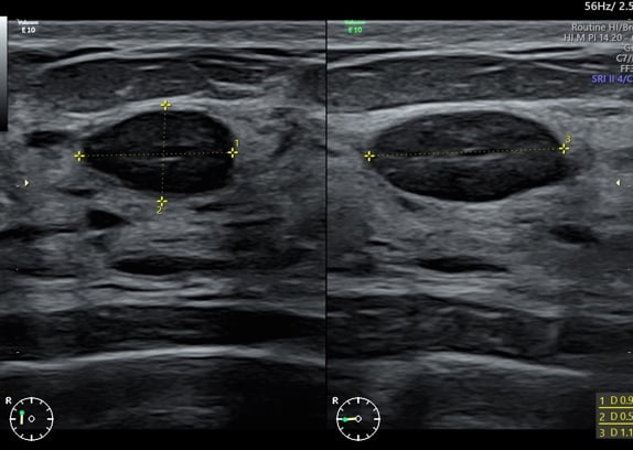 Ultraschallbild Mammasonographie mit hochauflösendem B-Bild