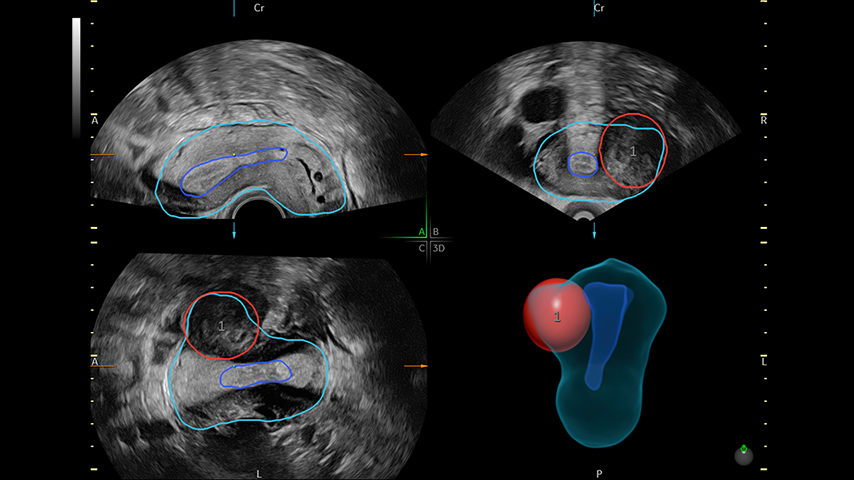 Combines our Uterine Trace tool and Fibroid Mapping feature, an AI reporting tool that standardizes and streamlines fibroid documentation by mapping, measuring, and classifying fibroids in 3D.