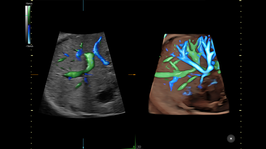 Fetal Abdomen with HDflow