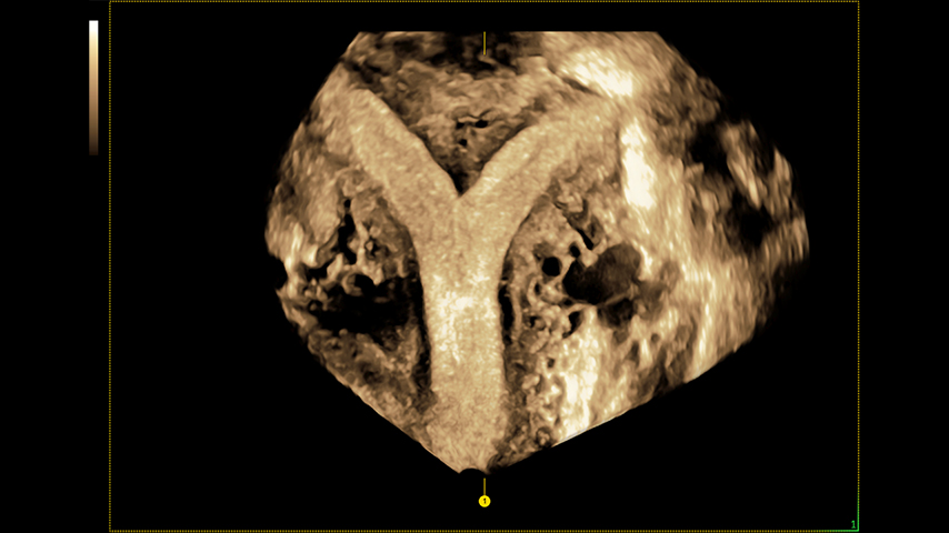 3D Uterus uterine trace