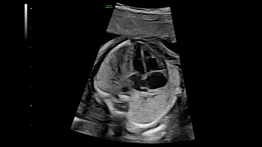 22 week fetal heart