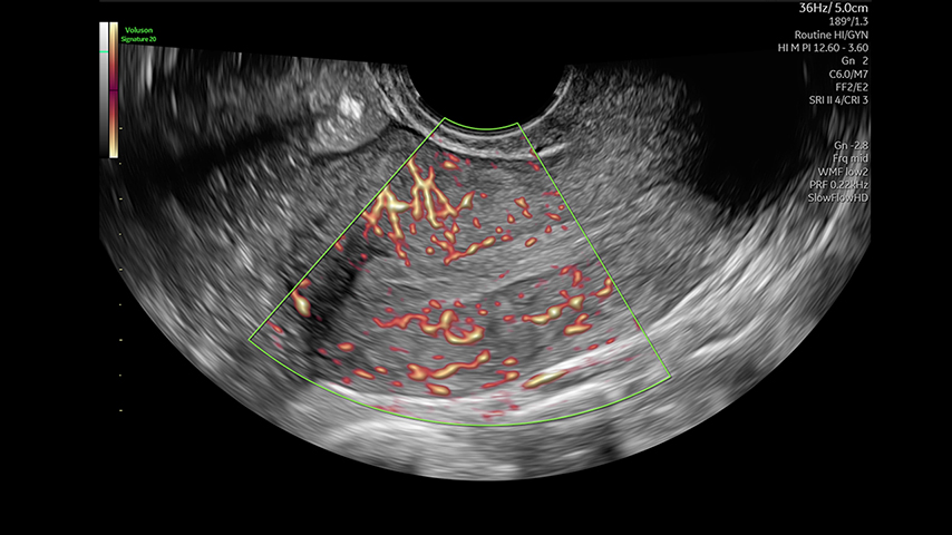 SFRF Uterus