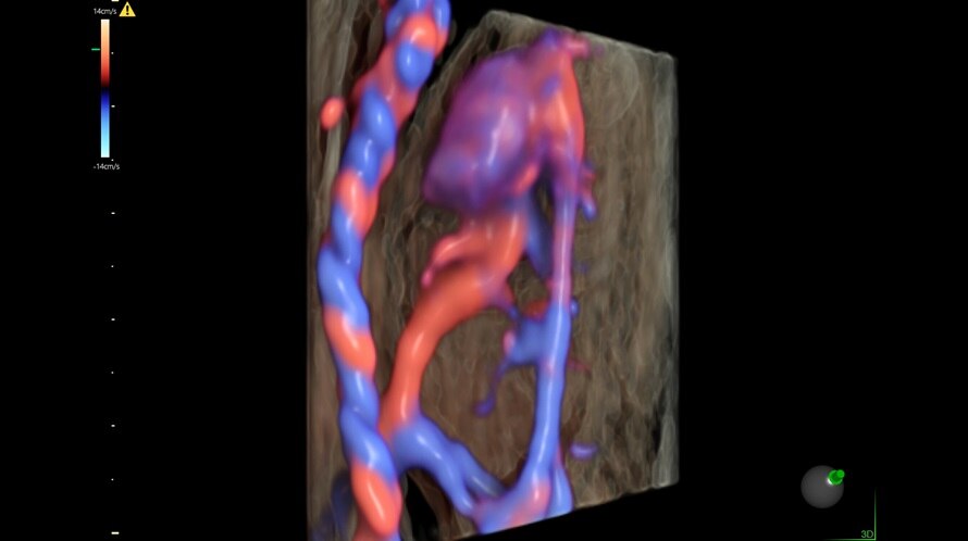 Ultrasound image of a 15-week fetal circulatory system captured with eSTIC and HD-Flow™.