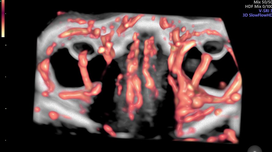 Obraz USG oczodołu 19-tygodniowego płodu uchwycony z wykorzystaniem funkcji SlowFlow HD.