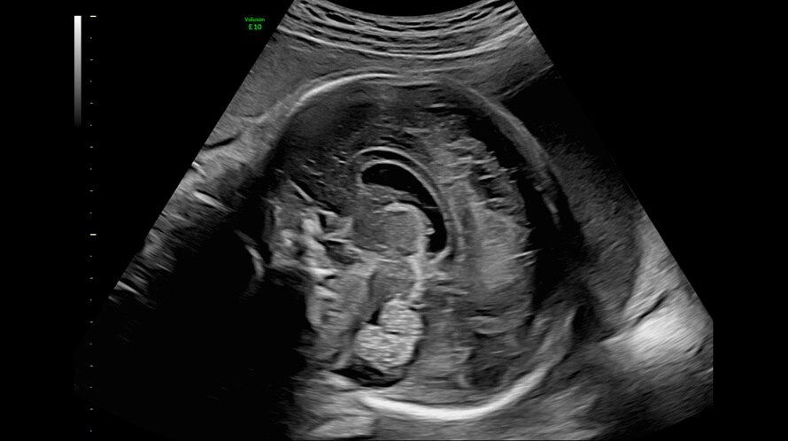 Ultrazvukový snímek mozku plodu zachycený pomocí funkce HDRes
