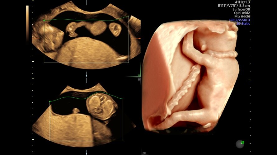 Ultrasound image of a fetus captured using HDlive