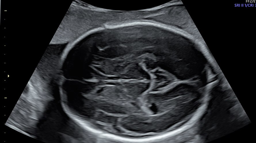 Ultrazvukový snímek hlavy plodu