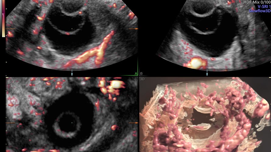 Ultrazvukový snímek ovariální cysty zachycené pomocí funkce Slowflow3D