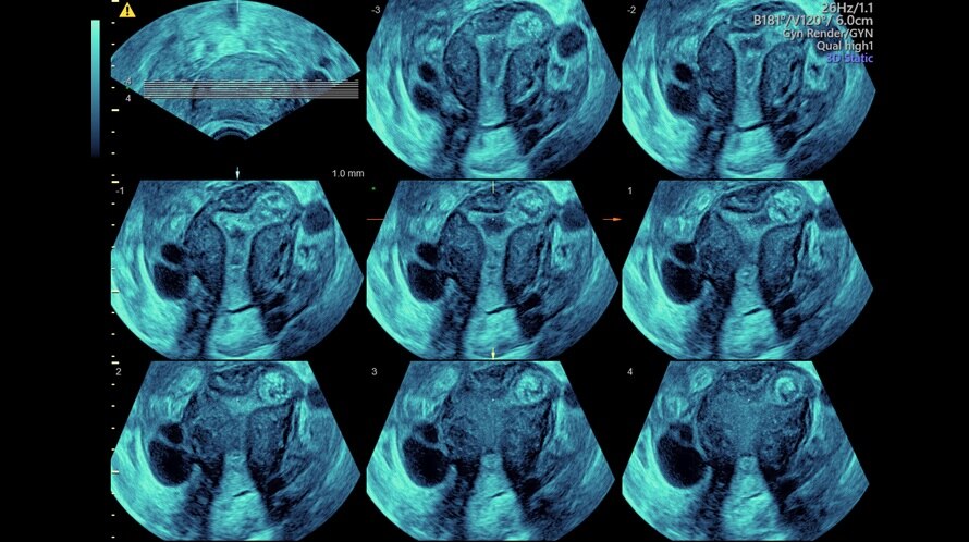 Ultrazvukový snímek děložní dutiny pomocí tomografického ultrazvukového zobrazení (TUI)