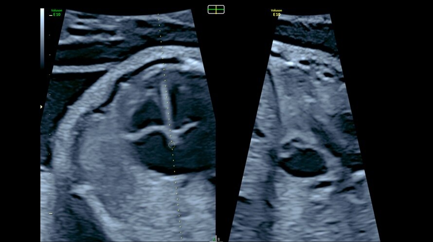 Ultrazvukový snímek zachycený pomocí biplanárního zobrazení e4D